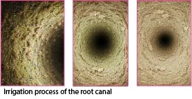 Root canal irrigation process demonstrating cleaning of dentinal tubules